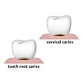 Cervical caries and root caries. Royalty Free Stock Photo